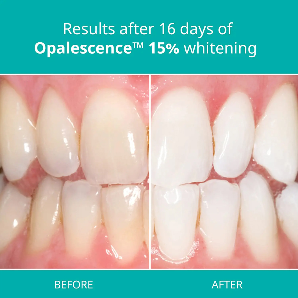 Teeth Whitening Gel Home Kit D - Teeth Whitening Gel Opalescence 评论和价格