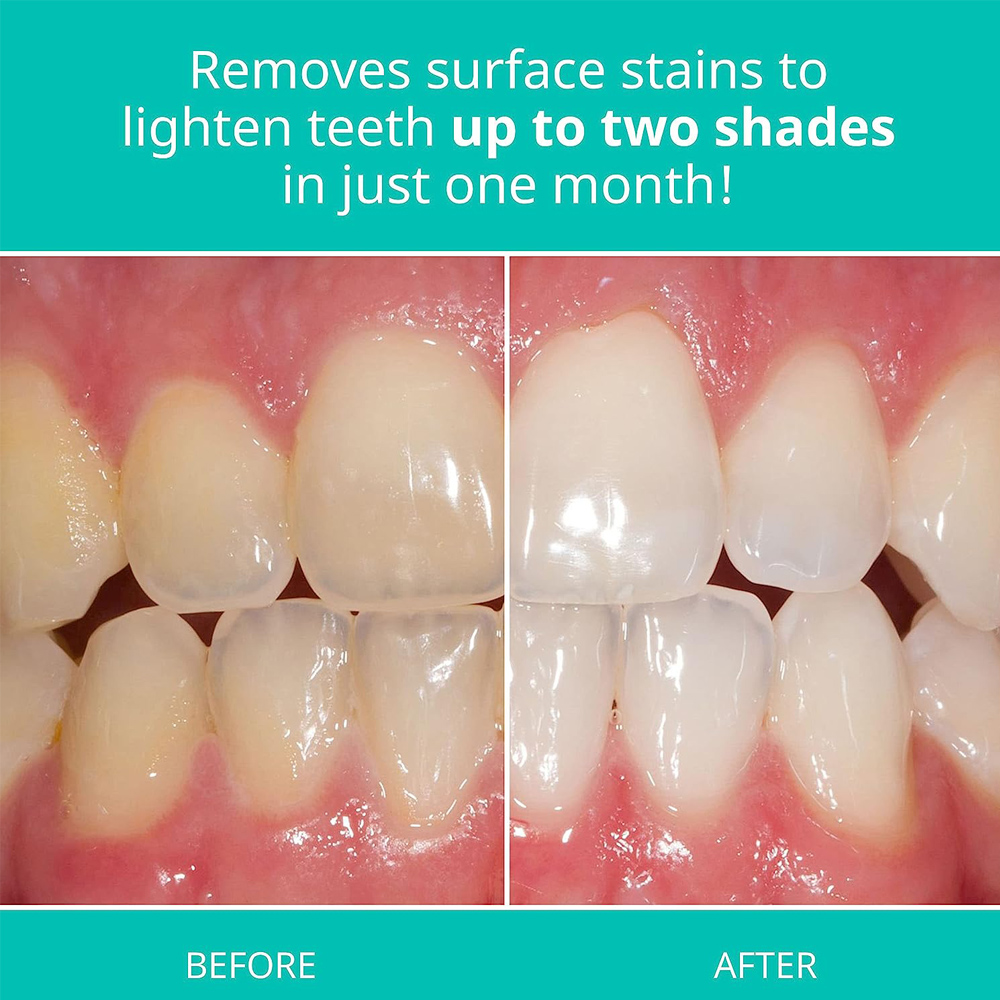 Opalescence Whitening Toothpas - Teeth Whitening Gel Opalescence 评论和价格