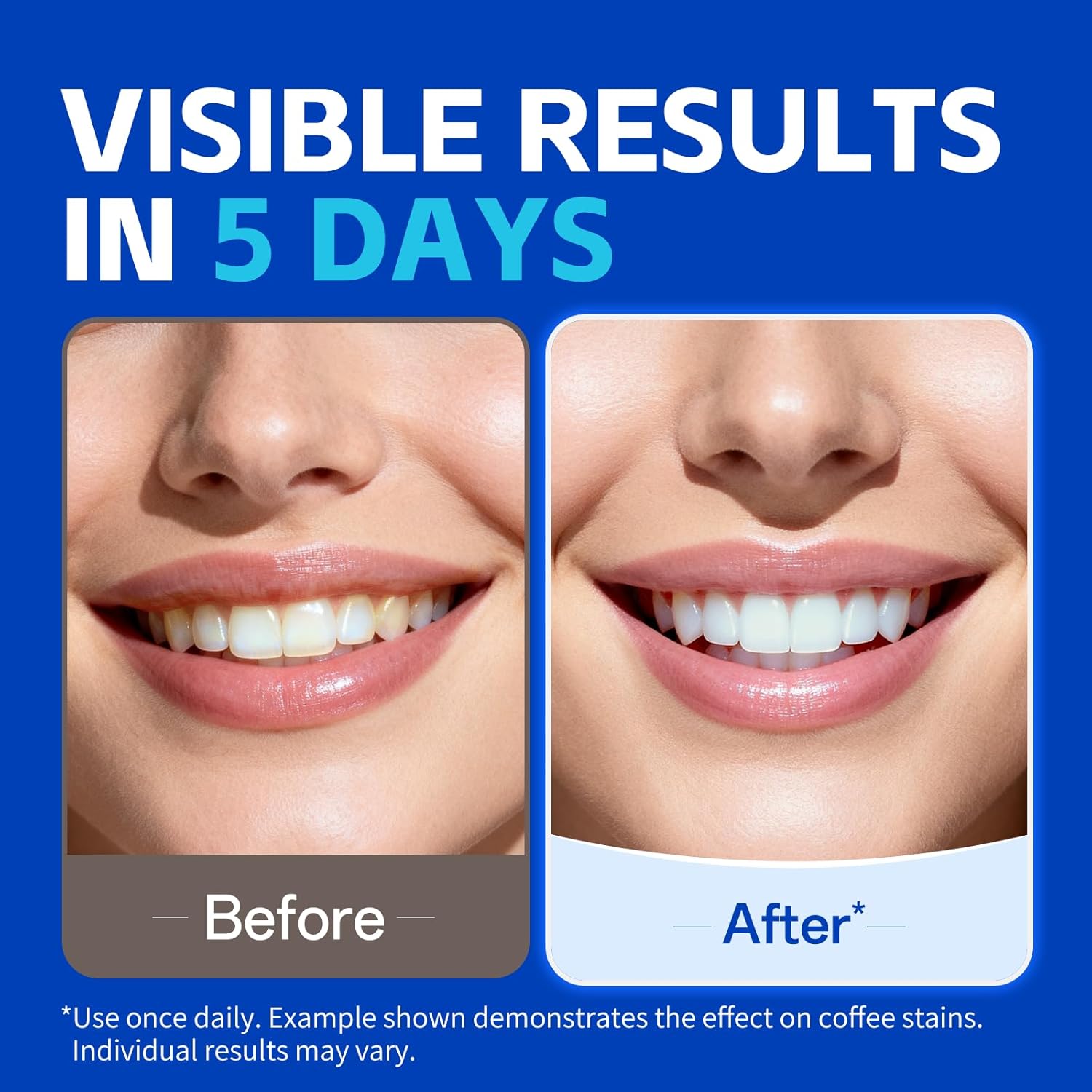 1/7 Pairs Teeth Whitening Stri - Teeth Whitening Strips Permanent 评论和价格
