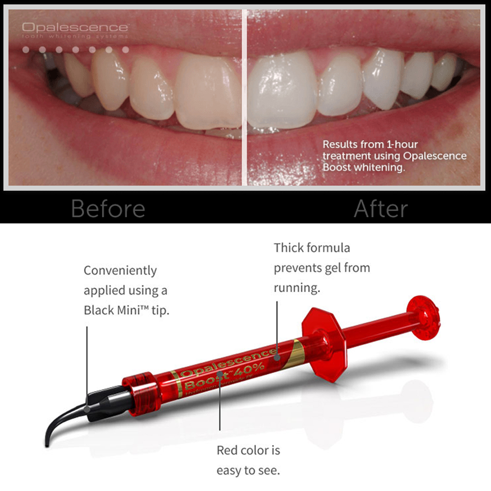 Ultradent Opalescence Boost PF - Teeth Whitening Gel Opalescence 评论和价格